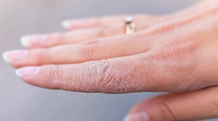Ovo čudo iz kuhinje liječi ispucale ruke bolje od kreme! Ovo čudo iz kuhinje liječi ispucale ruke bolje od kreme! - featured image